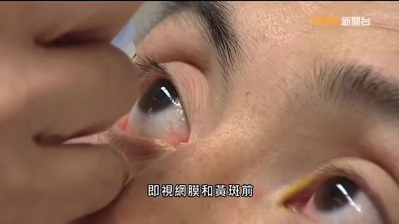 【杏林在線】朱東恆醫生 - 眼睛檢查防眼疾